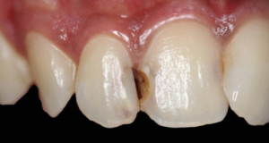 Class III caries visible between upper front teeth before composite filling treatment