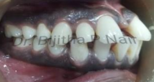 Left view of upper front teeth showing decay between teeth before treatment