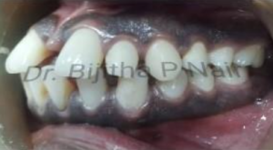 Right view of upper front teeth showing interproximal decay before treatment