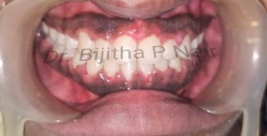 Upper front teeth after composite filling showing natural appearance and closed cavity