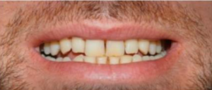 Visible yellow stains on front teeth before scaling and polishing treatment