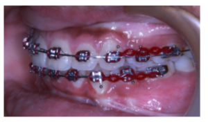 Frontal intraoral view showing arch alignment progress with orthodontic appliances