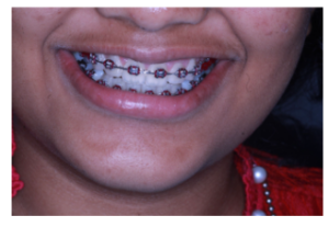 Frontal smile with fixed orthodontic braces during alignment phase