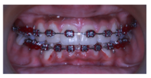 Right lateral view showing braces and alignment progress during treatment