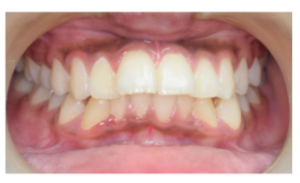Intraoral frontal view showing severe crowding and midline diastema before treatment