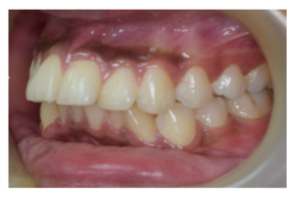Left lateral intraoral view showing posterior crossbite and crowding before treatment