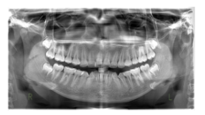 Orthopantomogram radiograph showing crowded dentition and root positions before treatment