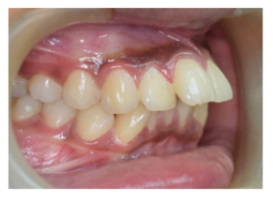 Right lateral intraoral view showing malocclusion and crowding before treatment