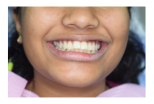 Frontal smile showing severe crowding and misalignment of teeth before orthodontic treatment