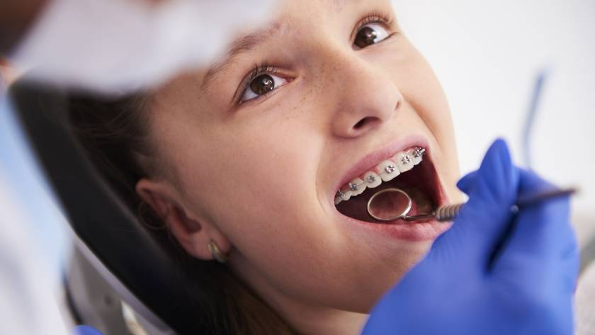 Teen patient undergoing braces treatment for crowded and forwardly placed teeth