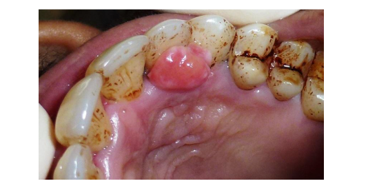 Patient Case Study Traumatic Fibroma Removal